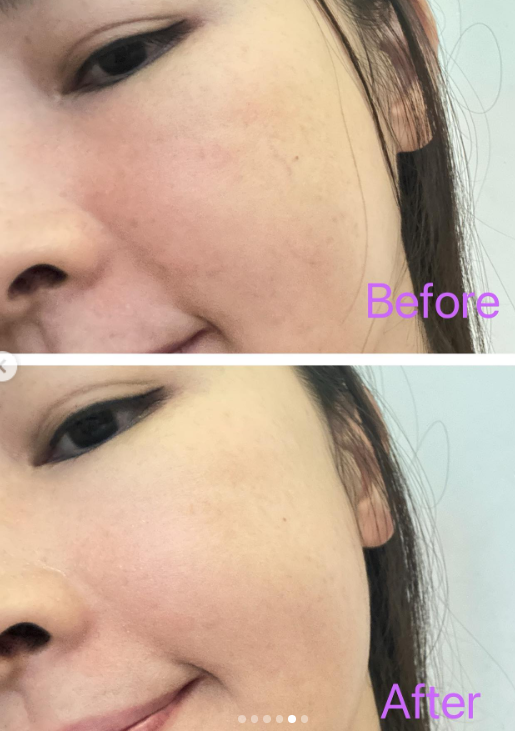 La Plante PDRN Bioleedle 100 (Vegan Ampoule / Firming & Lifting)