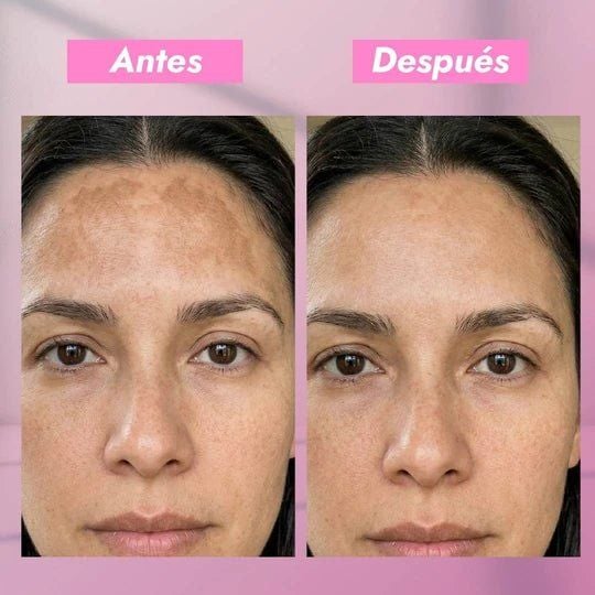 Locion Facial Onix Despigmentante