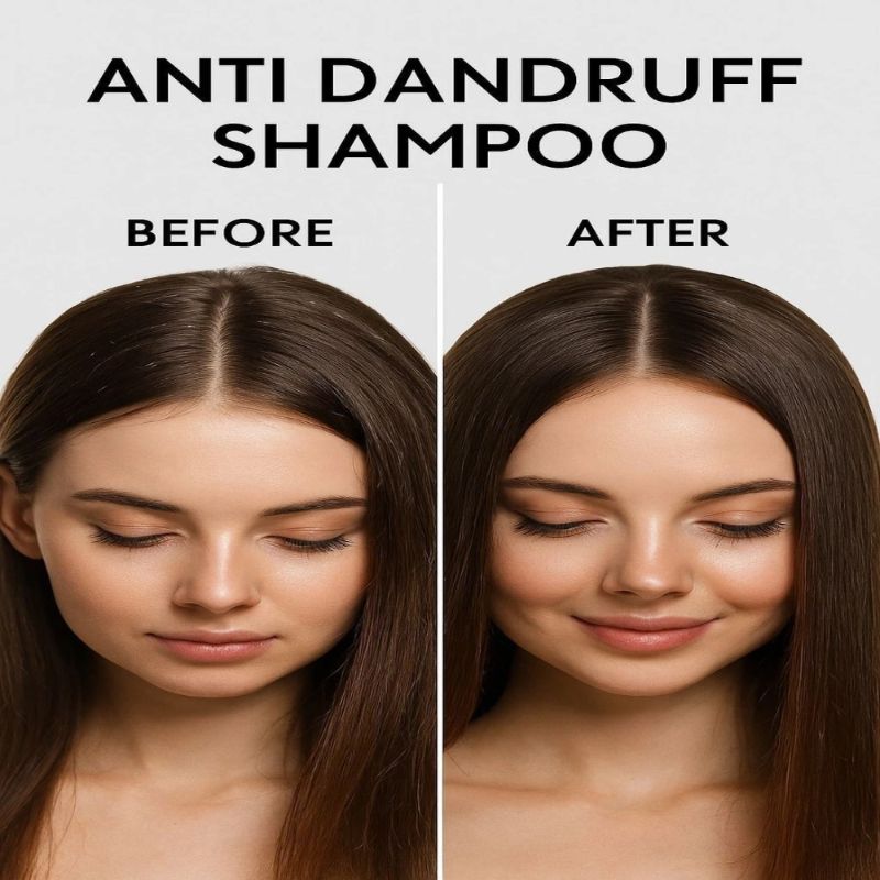 Winyfred – Anti Dandruff Shampoo (250 Ml)