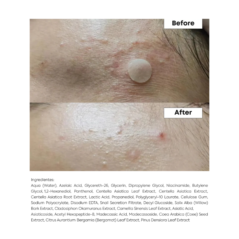 A-Control 10 Azelaic Acid Serum