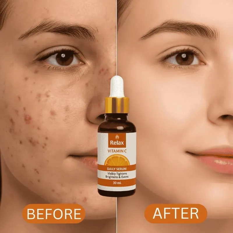 Vitamin-C Serum for Skin Brightening & Anti-Acne - 30ml Pack Of 1