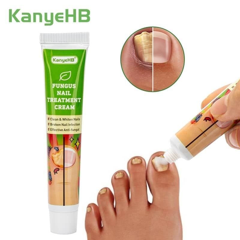 Crème de Traitement Antifongique pour les Ongles des Pieds