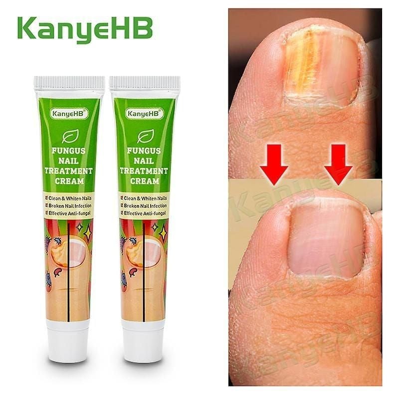 Crème de Traitement Antifongique pour les Ongles des Pieds