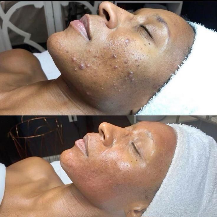Promo Soins de visage anti acnés