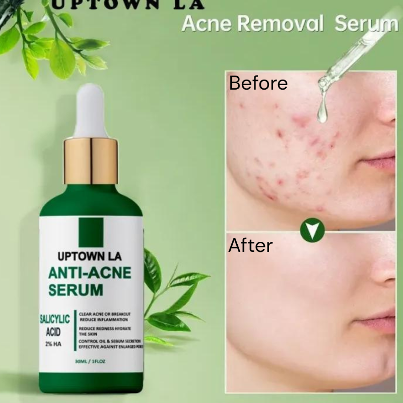 UPTOWN LA Anti-Acne Serum - Salicylic Acid Breakout Control