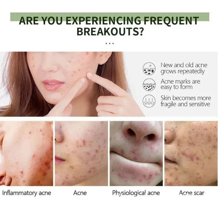 Uptown La Acne Scar Removal Gel