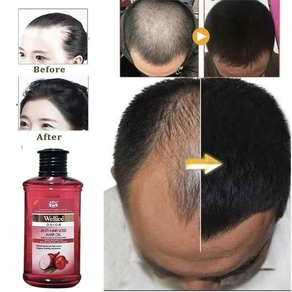 Anti Hair Fall Hair Oil