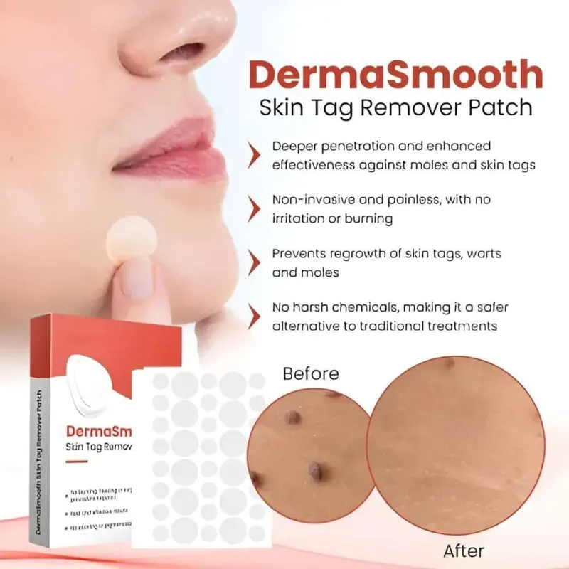 72 Pcs Skin Tag Remover - Affordable and Effective Solutions for Removing Skin Tags