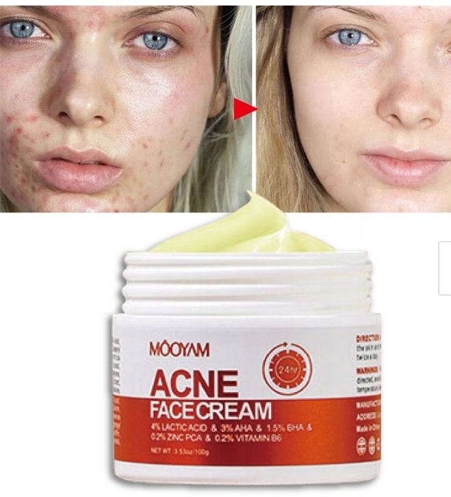 Crème contre acné hormonal