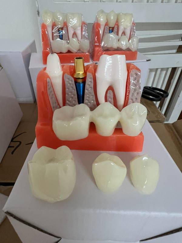 Mẫu hàm tư vấn Implant