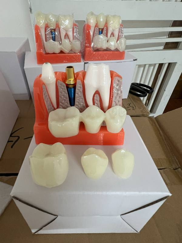 Mẫu hàm tư vấn Implant