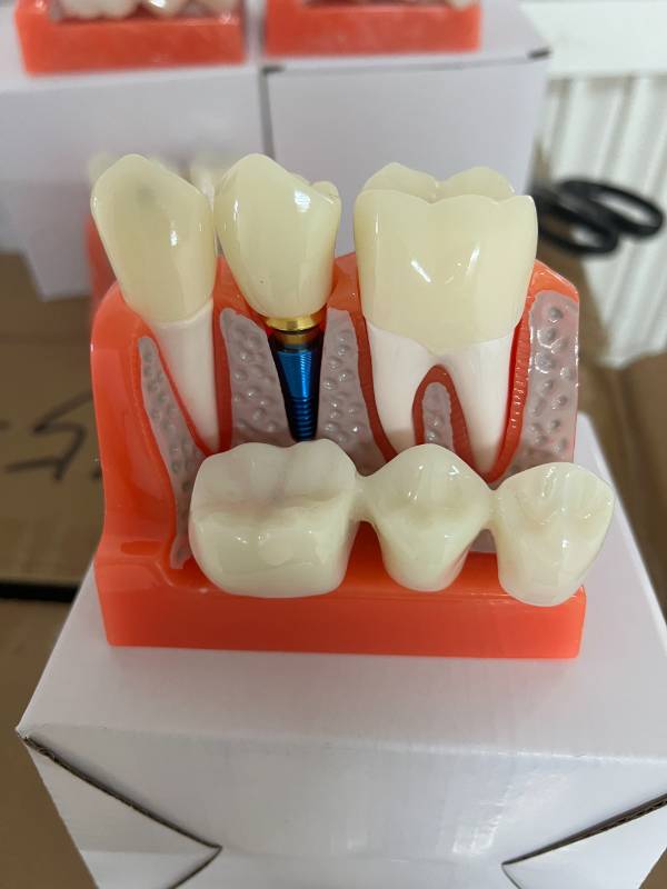Mẫu hàm tư vấn Implant
