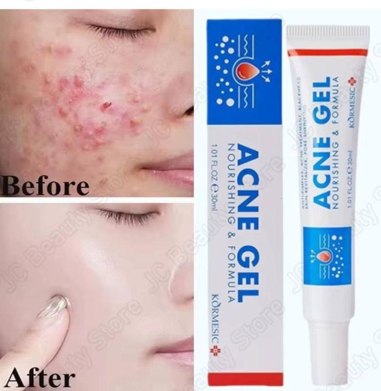 Acné gel 🩵